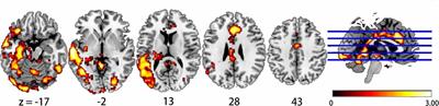 Abnormal Dynamics of Functional Connectivity Density Associated With Chronic Neck Pain